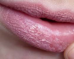 Lippenbalsem verslaving of droge lippen