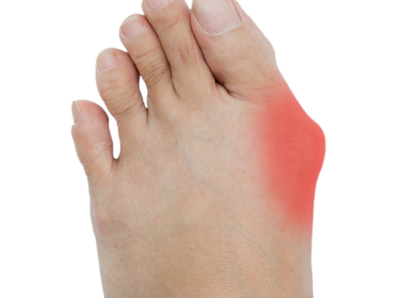 betekenis hallux valgus