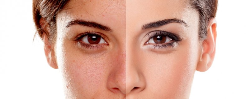 Crème tegen pigmentvlekken en andere tips voor een egale huid