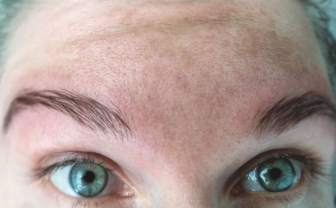 melasma verwijderen