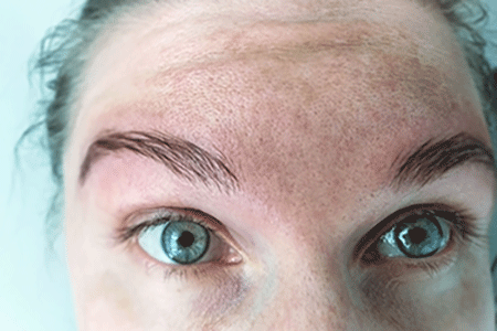 Melasma op voorhoofd melasma in het gezicht
