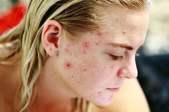 Donkere littekens door acne ontstaan door heftige acne