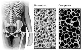 Hoe kan ik osteoporose- botontkalking verminderen? - 3