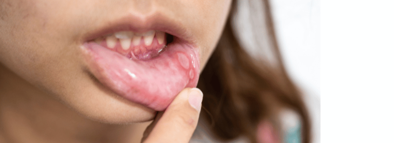 blaasje lip
