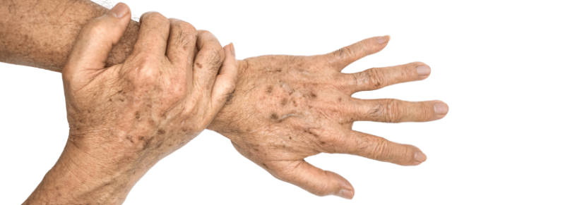 bruine vlek op hand bruine vlek op hand