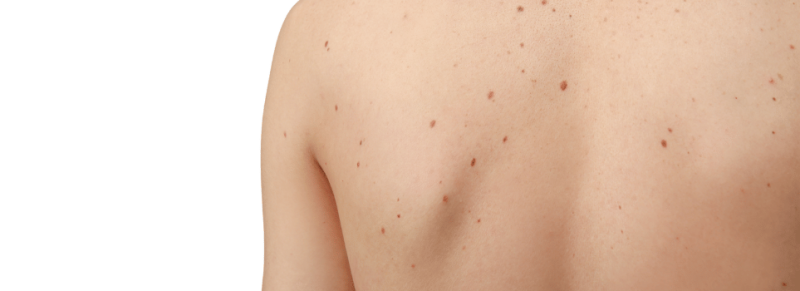 download de skinvision app download de skinvision app