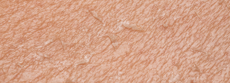 droge huid in de winter droge huid in de winter