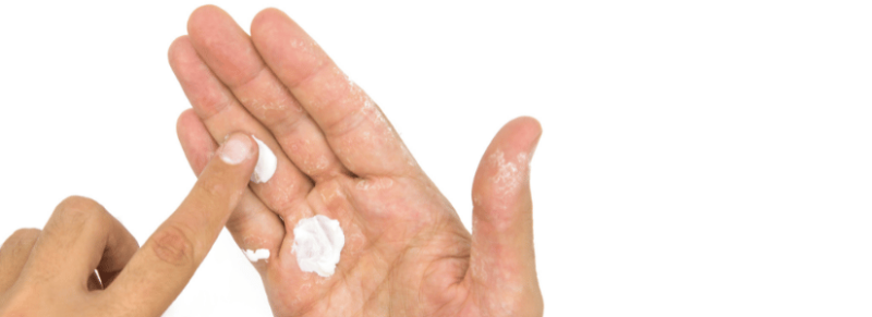 droge huid winter droge huid winter