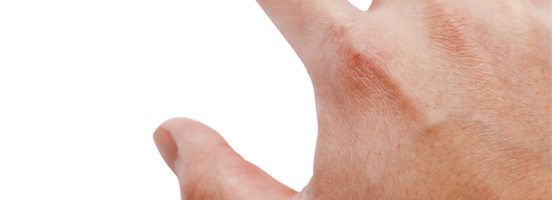 droge huid winter droge huid winter