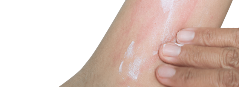 eczeem erger in de winter