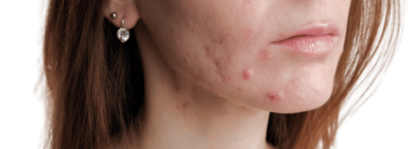 hormonale puisten kin