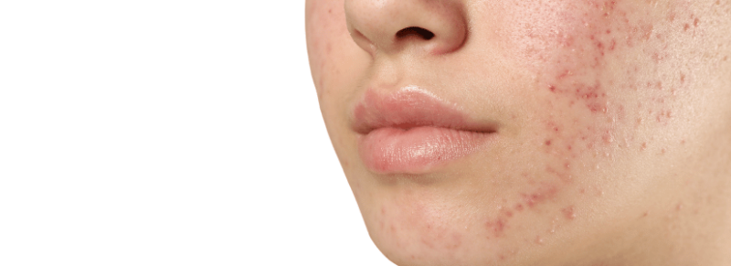 huidtherapie vergoeding