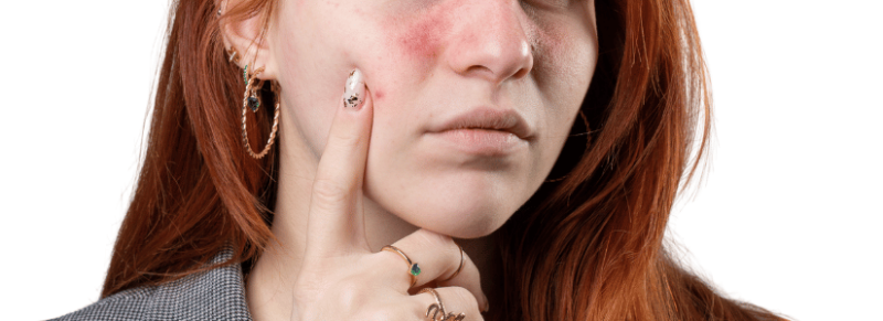 huidtherapie zorgverzekering