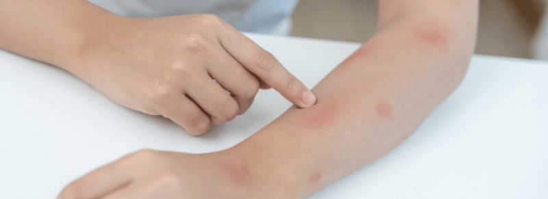 jeuk door droge huid