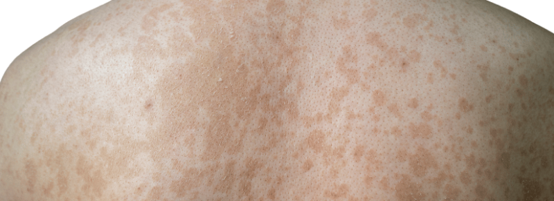 jeukende bruine vlekken op rug jeukende bruine vlekken op rug