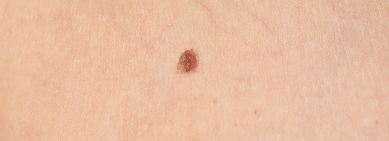 moedervlek check moedervlek check