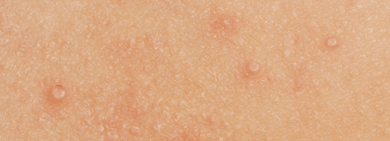 molluscum contagiosum behandeling