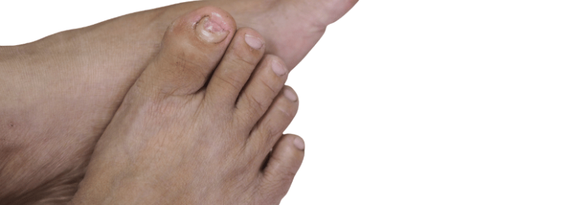 nagelschimmel azijn