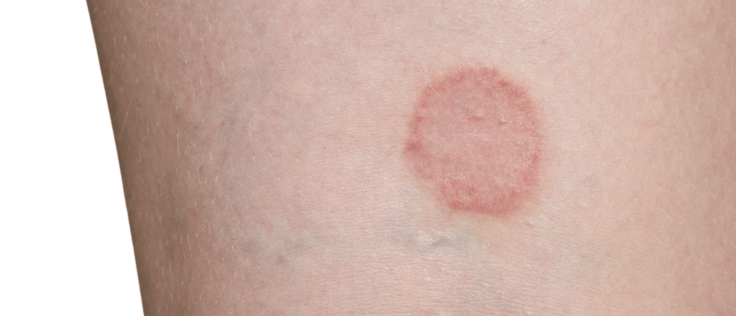 Ringworm: schimmelinfectie van de huid