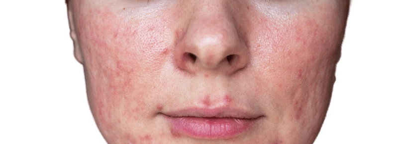 rosacea zwellingen