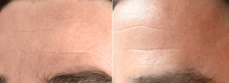 shark facialpro glow resultaat