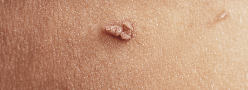 skin tags zelf verwijderen