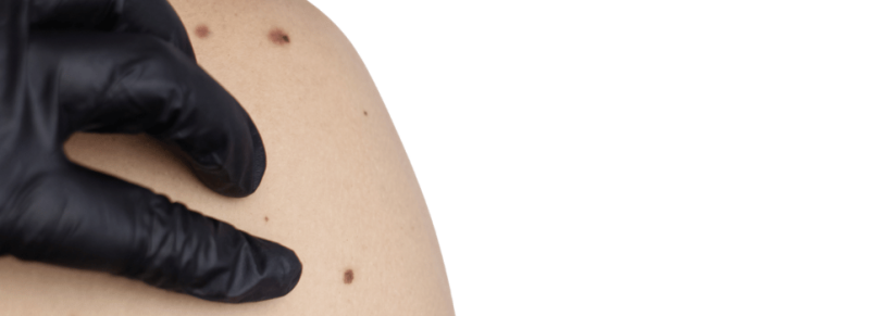 skinvision app skinvision app