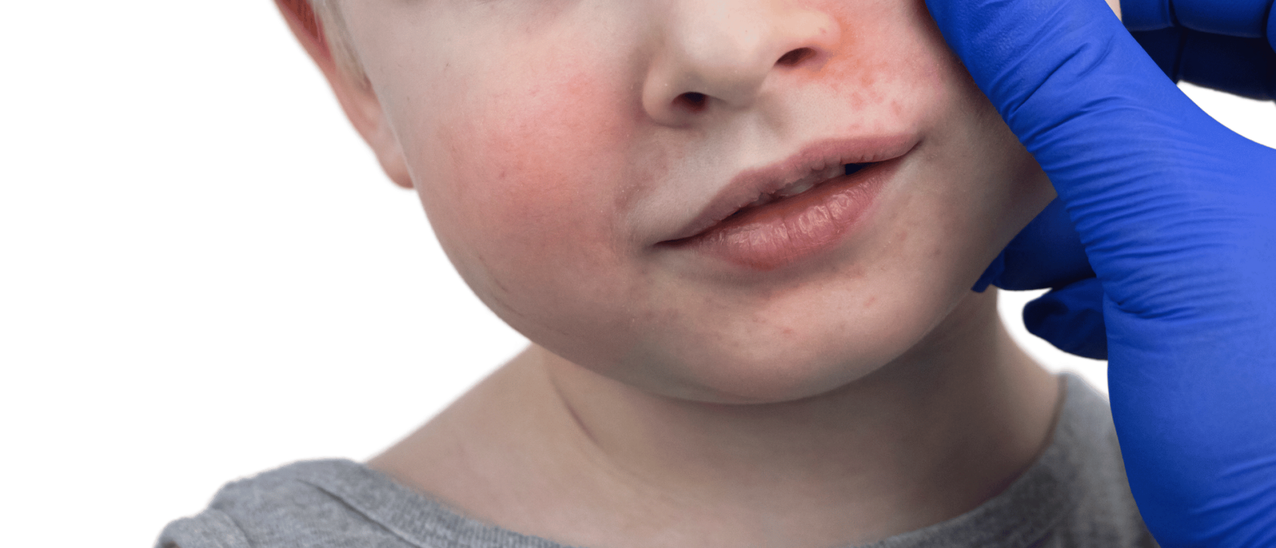 Vijfde ziekte: rode vlekjes op huid kind