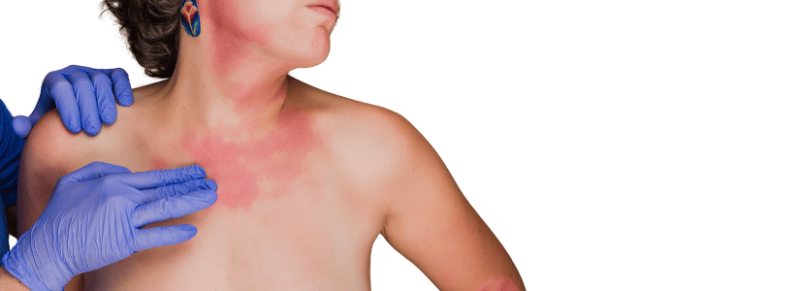 waarom eczeem in de winter