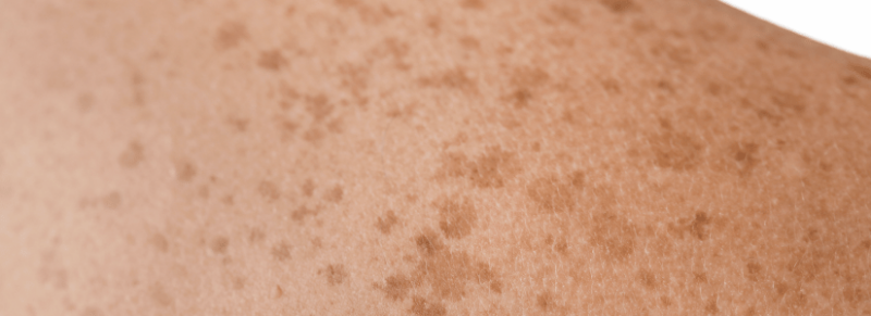 wat betekenen bruine vlekken op je huid? wat betekenen bruine vlekken op je huid?