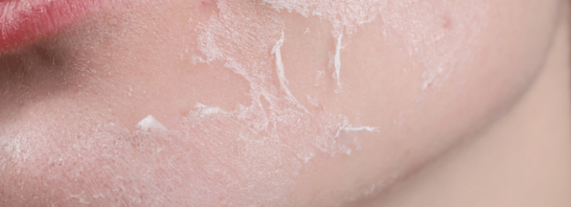 winter eczeem gezicht