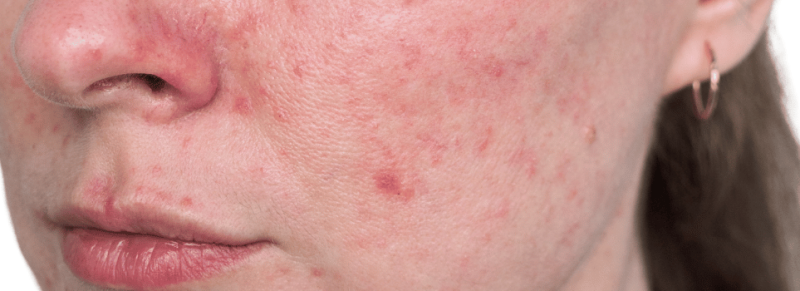 zonnebrandcreme rosacea