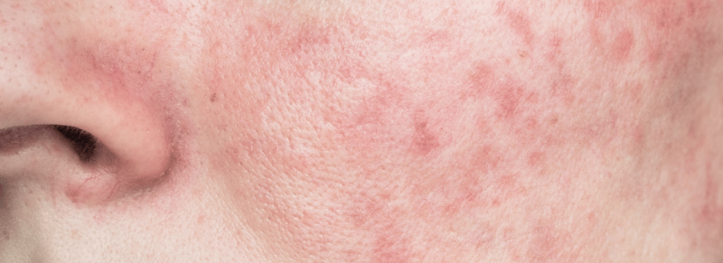 zonnebrandcreme rosacea