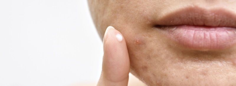 acne littekens