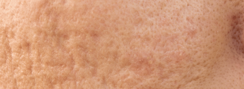 acne littekens