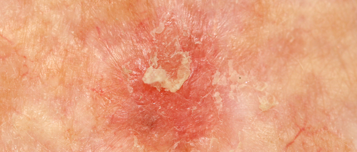 Actinische keratose: voorstadia van huidkanker