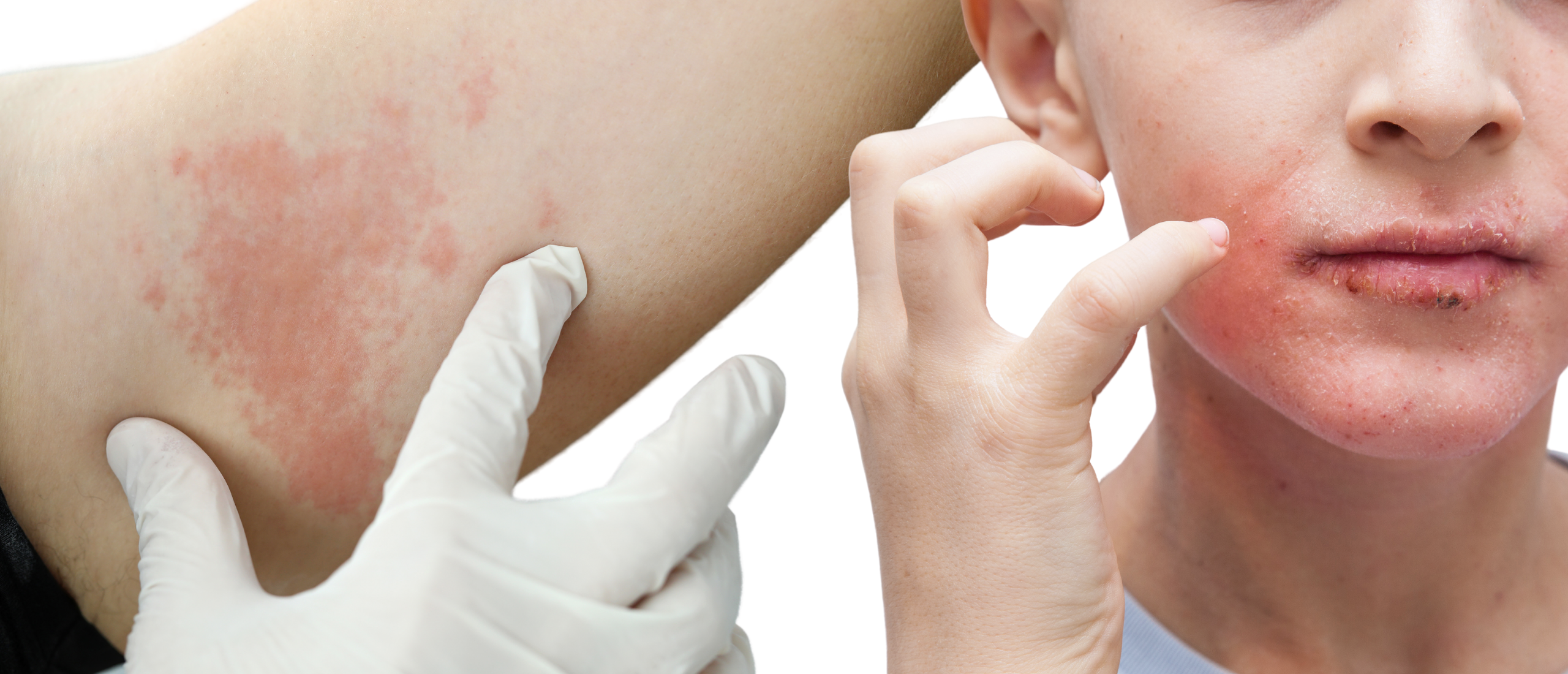 Huid allergieën: rode, gezwollen, jeukende huid