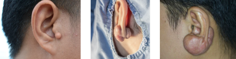 keloid oor