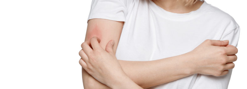 vrouwelijk kaart pijn Brandende huid | Oorzaak en tips | Sproetonline
