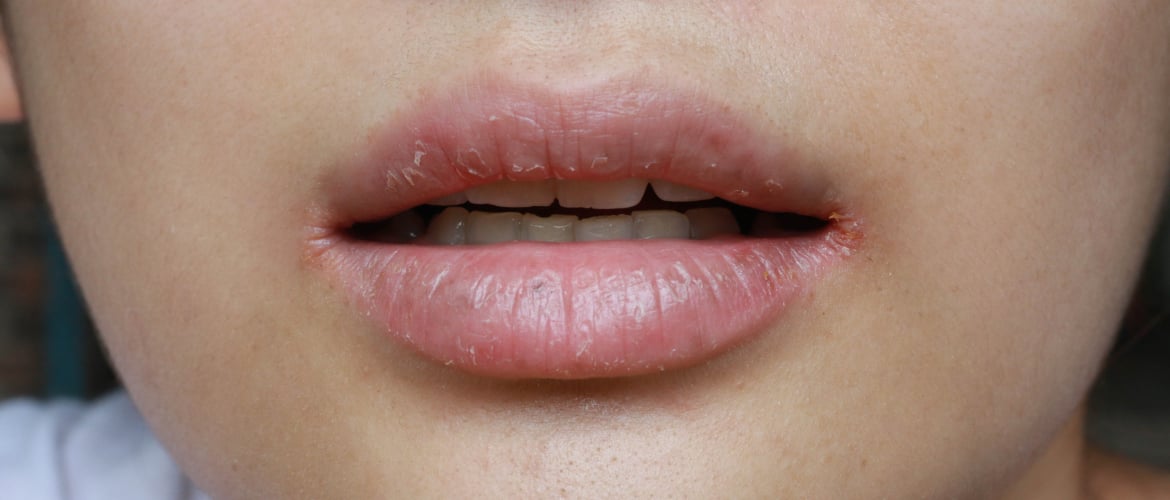 Droge lippen: velletjes, schilfertjes en irritatie
