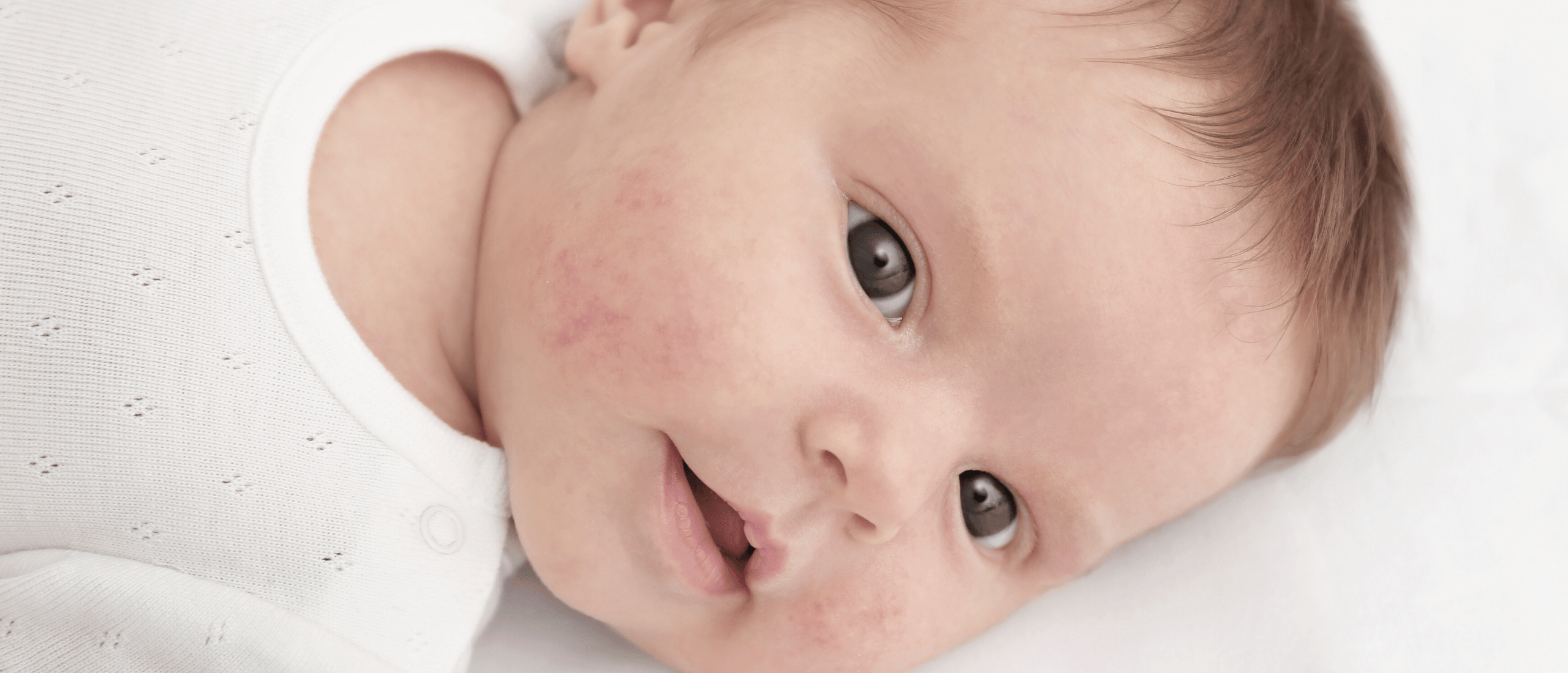 Baby eczeem: rode, droge baby huid