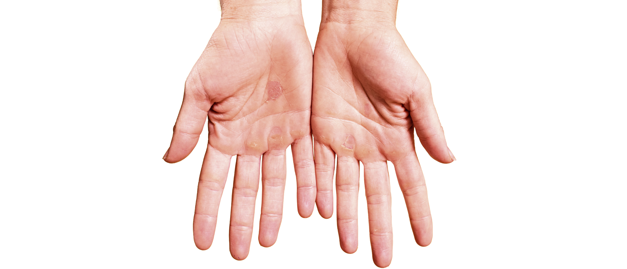 Eelt op hand: ruwe en harde handpalmen
