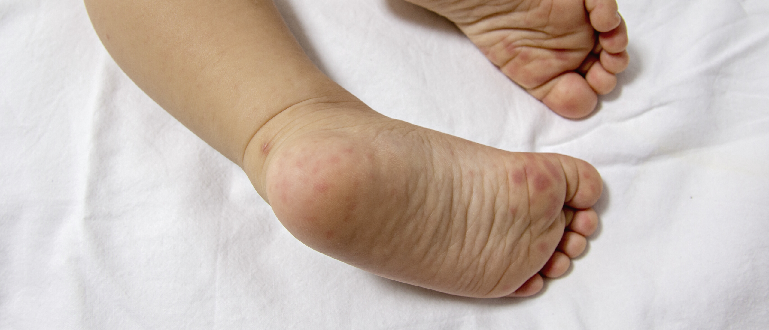 Hand-voet-mondziekte: vlekjesziekte kind