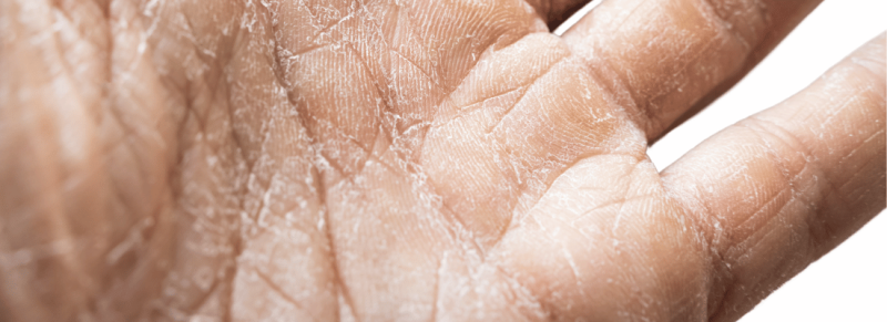 handcreme tegen droge handen