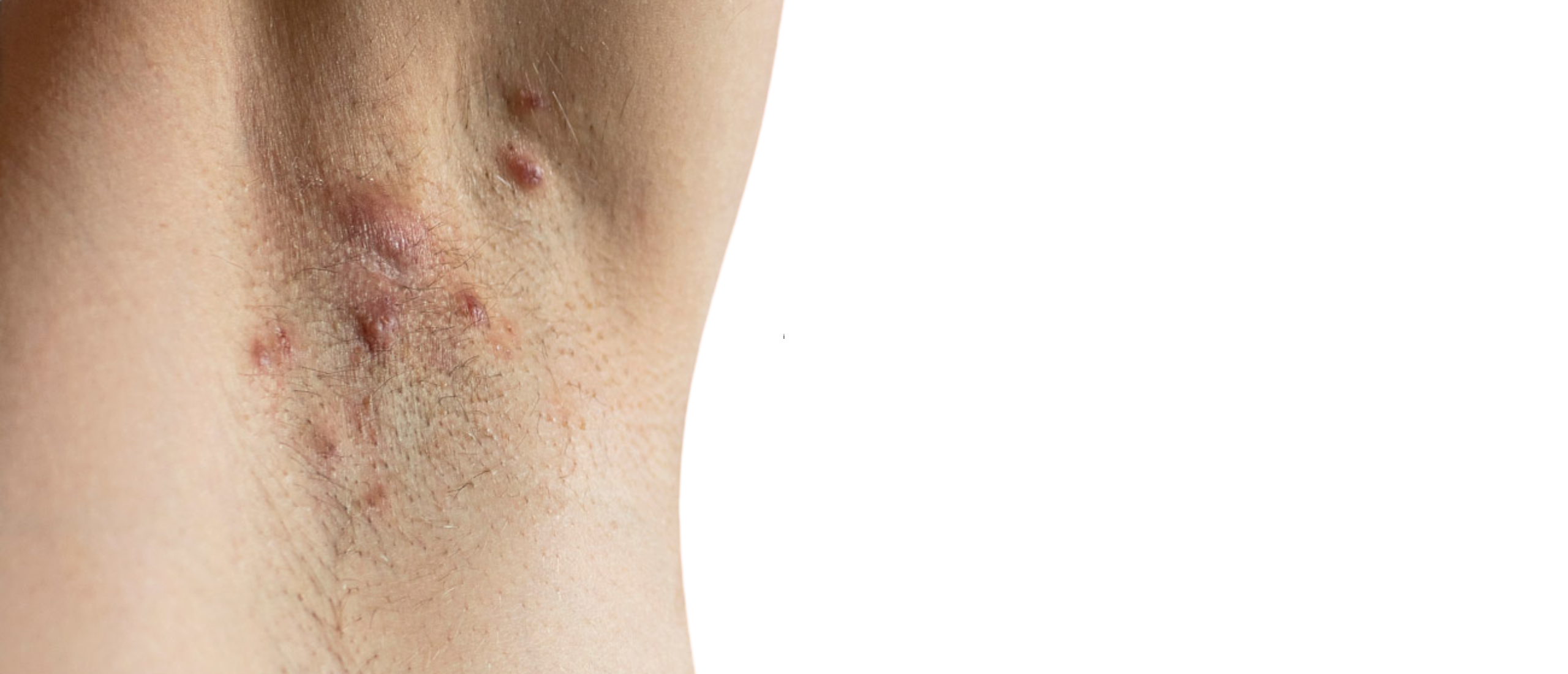 Hidradenitis Suppurativa: pijnlijke ontstekingen in de huidplooien