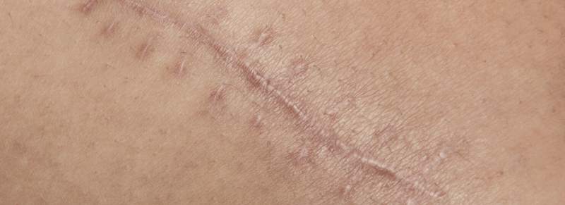 hyperpigmentatie litteken