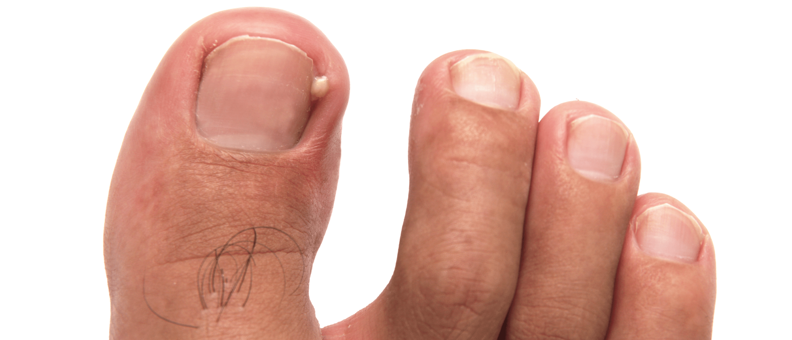 Ingegroeide nagel: aan tenen of vingers