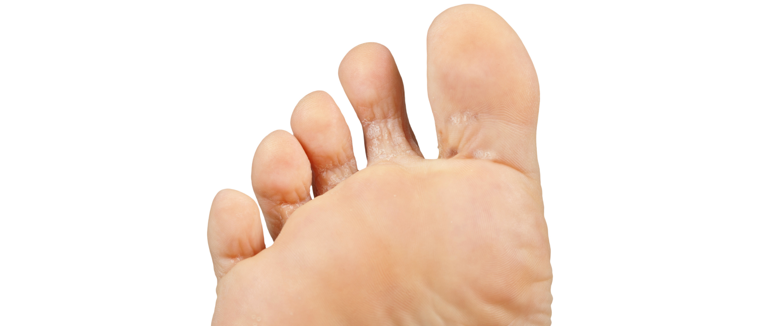 afwijzing Schadelijk eiwit Voetschimmel | Jeuk onder voeten | Oplossing | Sproet