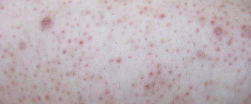 rode puntjes op de huid