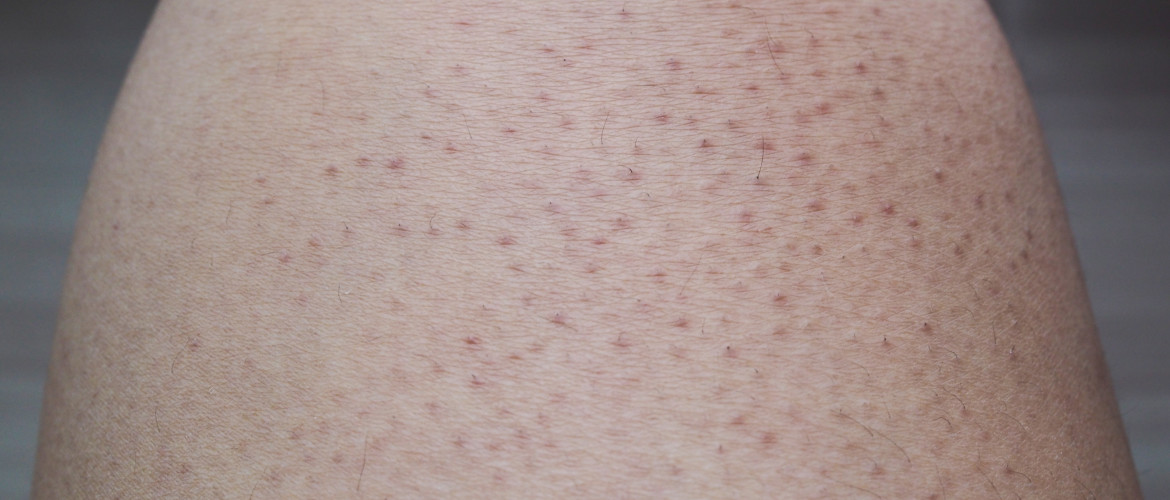 Keratosis Pilaris: rode puntjes op de huid